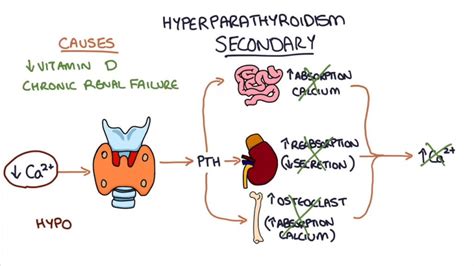 Hyperparathyroidism Symptoms Causes And Risk Factors