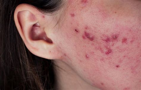 Different Types Of Acne And How To Treat Them Effectively Acne Rosacea