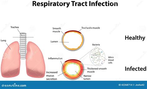 Rintihan Nurani Upper Respiratory Tract Infection Urti