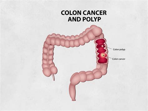 Polypectomy Procedure Cape Town Gastric Polyp Removal