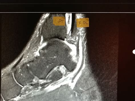 Foot And Ankle Problems By Dr Richard Blake Posterior Tibial Tendon Tear Mri Images
