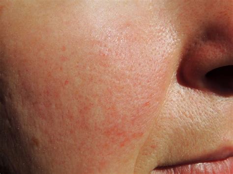 How To Get Rid Of Skin Conditions That Arent Acne