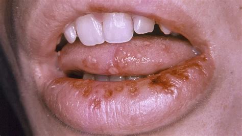 Cold Sore On Tongue Diagnosis Treatments And Symptoms