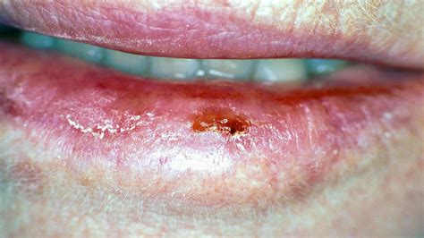 Cherry Angioma On Lip Pictures Birthmarks Treatment With Vascular