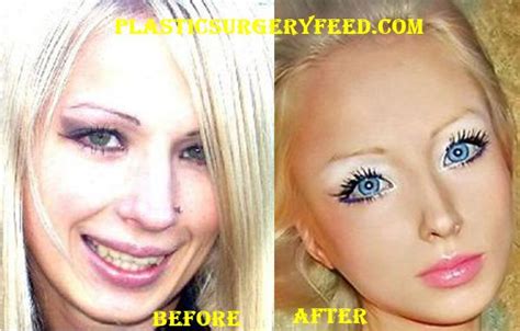 Barbie Plastic Surgery Plastic Surgery Feed