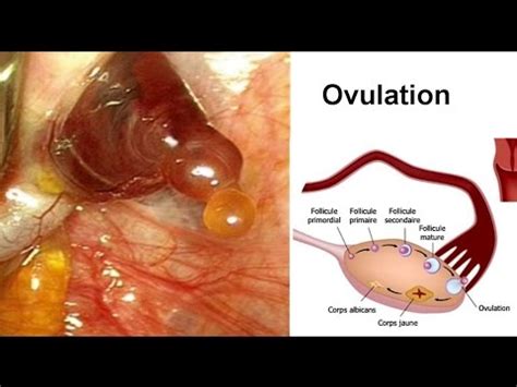 Saignement entre les Règles Hémorragie Vaginales Métrorragies YouTube