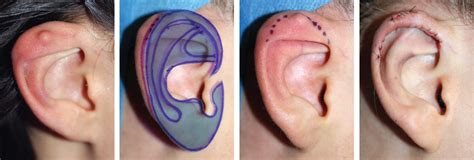 Anomalies Of The Upper Part Of The Ear Plastic Surgery Key