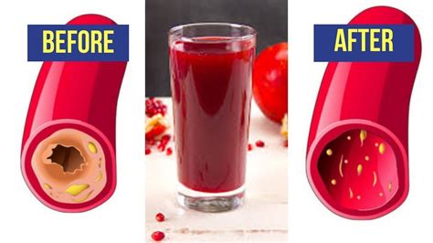 This Juice Unclogs Arteries And Protects Against Heart Disease