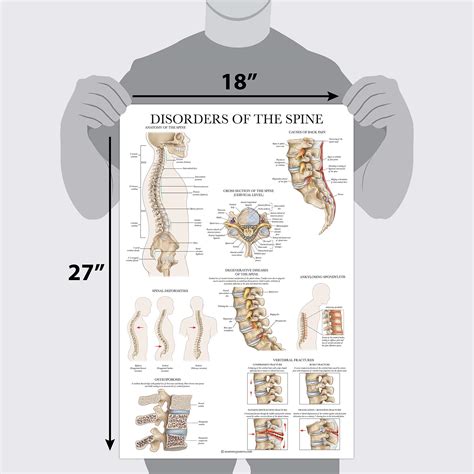 Disorders Of The Spine Anatomy Poster Laminated Spinal Disorders