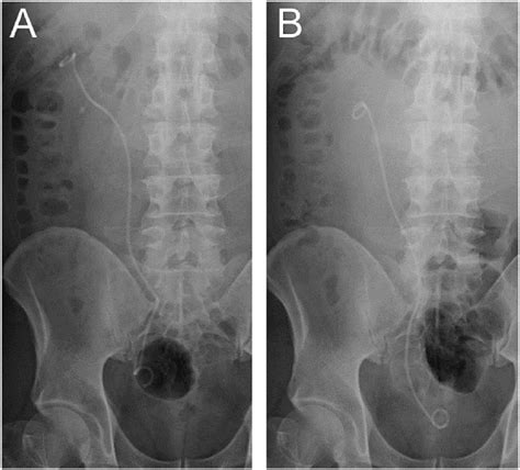 An Abdominal Plain Radiography Scan A Pre And B Post Second