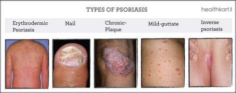 Symptoms Of Psoriasis That Shouldnt Be Overlooked Healthkart