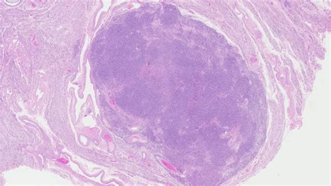 Leiomyoma Of The Uterus Mypathologyreportca