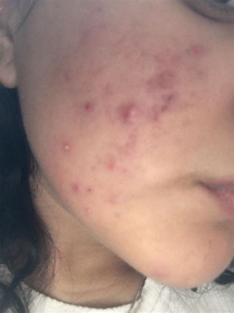 I Cant Tell If I Have Cystic Acne General Acne Discussion By