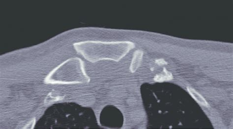 Computed Tomography Scan Showing Dislocation Of The Sternoclavicular