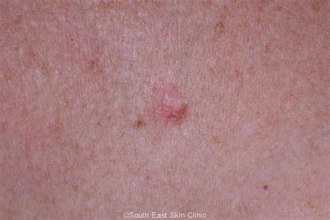 Iec Intraepidermal Carcinoma South East Skin Clinic