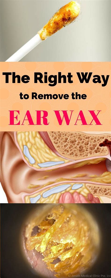 Pin By Hearing Loss Health On Hearing Loss Ear Wax Healthy Tips Ear