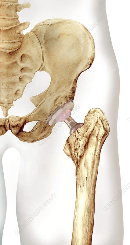 Hip Replacement Artwork Stock Image C009 7661 Science Photo Library