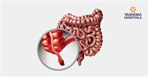 Laparoscopic Appendix Removal Surgery