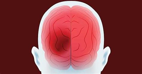 5 Causas Que Provocan Hemorragias Cerebrales