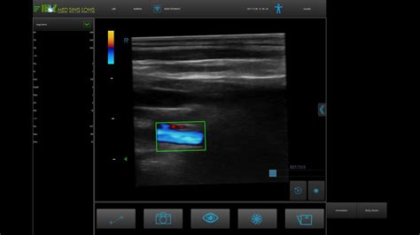 Ultrasound Analysis For Vertebral Artery MSLCU89 YouTube