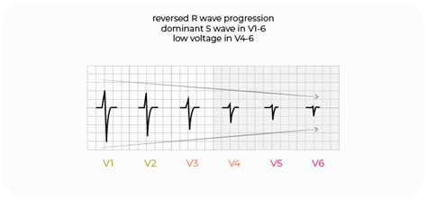 Dextrocardia On Ecg