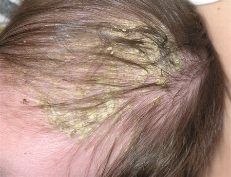Bits And Bites Of Parenting Info My Baby Has Flaky Scalp Is It Normal