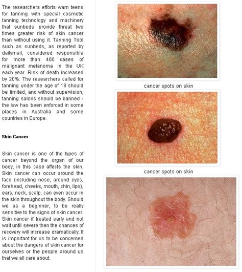 Skin Cancer Skin Cancer Advices