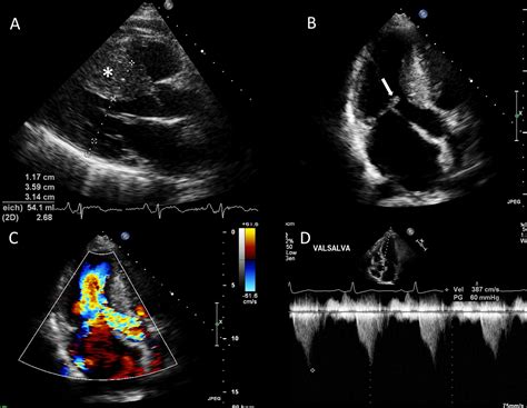 Echocardiography Findings In Common Primary And Secondary