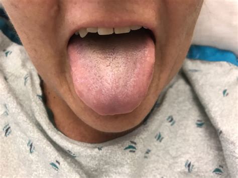 A Rare Case Of Black Hairy Tongue Has Been Treated In The Us Express