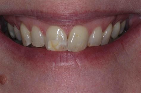 Before And After Dental Bonding Photos Cosmetic Bonding Dentists