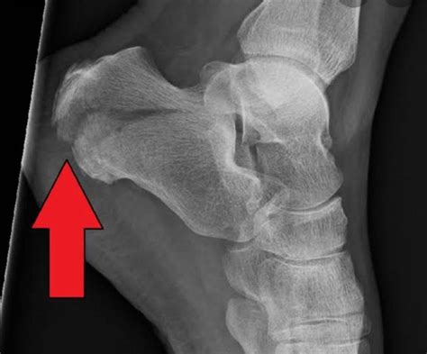 Calcaneum Heel Bone Fracture Symptoms Diagnosis And Treatment Dr