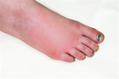 Allergic Reaction To Insect Bite Photograph By Dr P Marazziscience