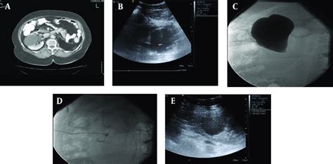 A 56 Year Old Man With Bosniak Type 1 Cyst In The Right Kidney With