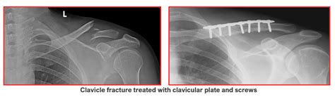 Clavicle Fractures Home Consultant Orthopaedic Surgeon