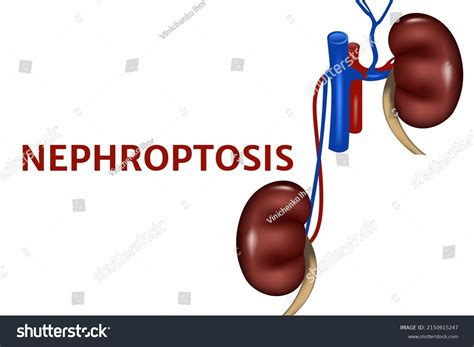 Nephroptosis Anatomical Poster Drooping Kidney Vector Stock Vector