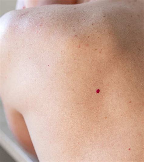 Cherry Angioma Causes Treatments And Risk Factors