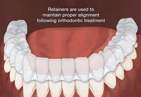 In many cases, retainers are necessary while sleeping for many years following the removal of braces. Retainers | Charleston Center For Cosmetic Dentistry