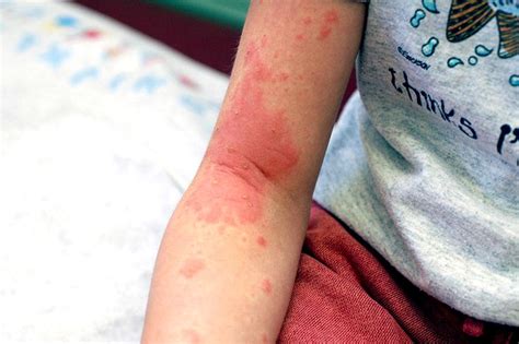 Poison Ivy Oak And Sumac In Children Poison Ivy Remedies Home