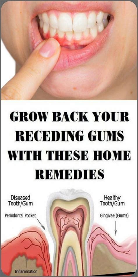 Natural Ways To Grow Back Your Receding Gums Receding Gums Grow Back