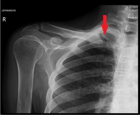 Double Trouble An Unusual Presentation Of Cervical Cord Herniation