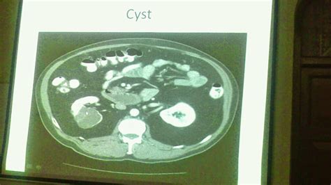Lecture Slides Urology Renal Cell Carcinoma