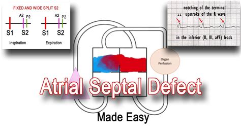 Atrial Septal Defect Asd Pathophysiology And Clinical Features Youtube