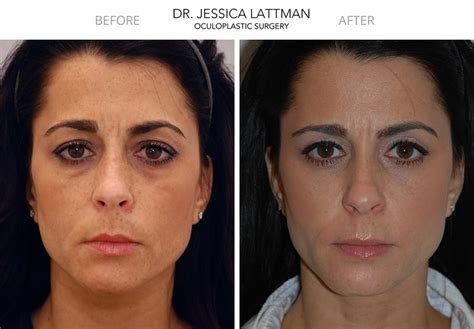 blepharoplasty eyelid surgeon nyc eyelid lift new york manhattan specialist dr jessica lattman