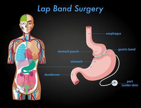 What Is Lap Band Surgery Procedure Memorial Weight Loss Center