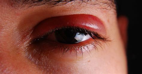 In this article, we look at reasons for feelings of pressure behind the eye, including a migraine or sinus infection. Shingles in the eye: Symptoms, treatment, and prevention