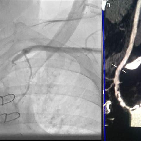 A Sub Occlusive Stenosis Of Left Subclavian Artery On Angiogram B
