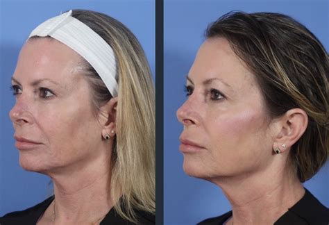 Facetite Blog Savannah Facial Plastic Surgery