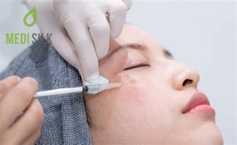 Dermal Fillers For Acne Scars The Ultimate Guide • Medisilk