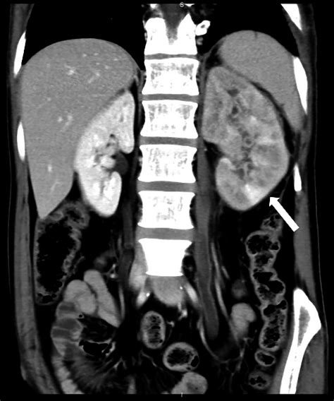 Coronal Axial Ct Section In The Nephrographic Phase In A 23 Year Old
