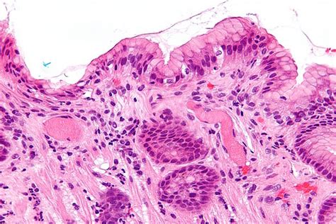 Gastric Antral Vascular Ectasia Libre Pathology